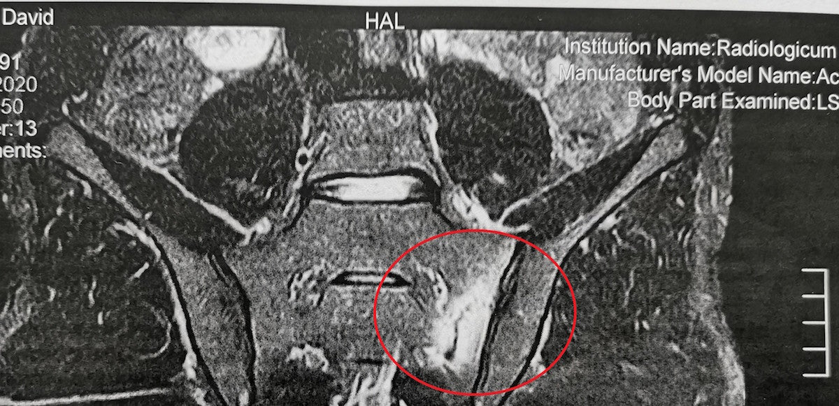 hip injury stress fracture
